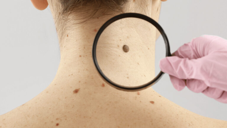 Langkah Pencegahan Alami untuk Papiloma dan Parasite